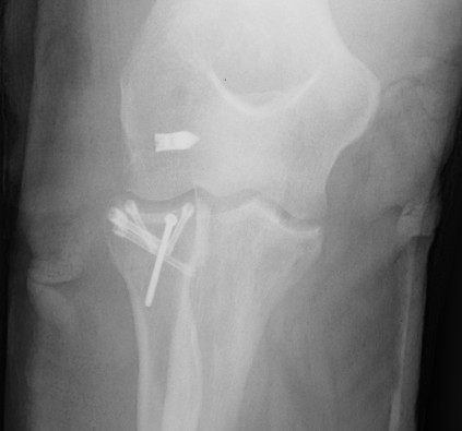 Radial Neck Fracture ORIF Screws AP